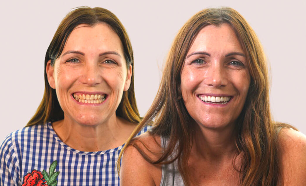 What you should know about porcelain veneers before fixing your smile